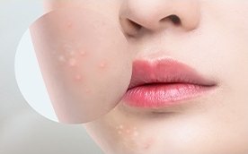 비염증성 여드름(화이트헤드)이 오돌토돌하게 보이는 볼과 입술 클로즈업