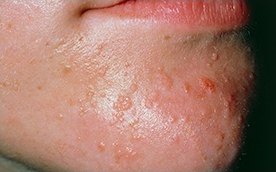 턱선과 볼에 곪은 병변이 다수 보이는 성인형 여드름 피부 클로즈업
