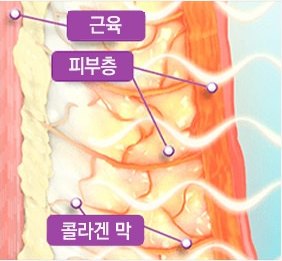 고주파 열이 전달된 피부 단면 일러스트 — 조직이 달아오르고 흰 고주파 파형이 지나간다. 근육·피부층·콜라겐 막 위치가 표시돼 있다