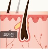 모공 단면 일러스트 — 피지선이 발달해 피지가 과다 분비되는 단계. 그림 안 라벨: 피지선