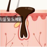 모공 단면 일러스트 — 각질과 노폐물이 모공 입구를 막은 단계. 그림 안 라벨: 각질 및 노폐물