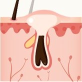 모공 단면 일러스트 — 막힌 모공 안에 염증이 생긴 단계