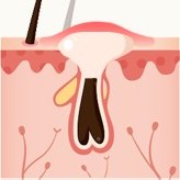 모공 단면 일러스트 — 염증이 악화되어 모공이 넓어진 단계