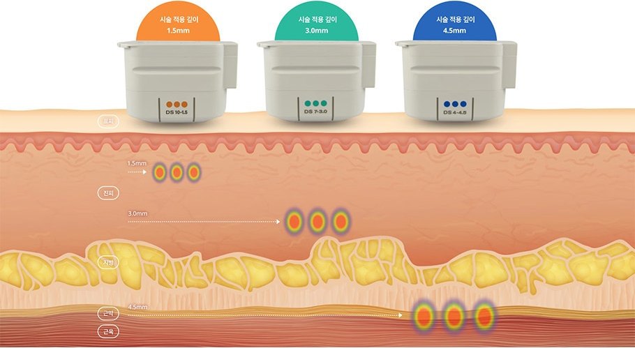 시술 적용 깊이 1.5mm·3.0mm·4.5mm 카트리지(DS 10-1.5 · DS 7-3.0 · DS 4-4.5)가 표피·진피·지방·근막·근육 단면 위에서 각 깊이에 열응고점을 만드는 레이어드 리프팅 도해