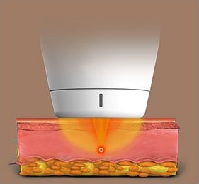 1.5mm 팁이 피부에 밀착해 진피층에 열에너지를 확산시키는 단면 일러스트