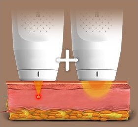 두 종류의 핸드피스를 교차 시술하는 원리를 보여주는 단면 일러스트