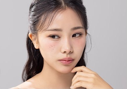 광대에 갈색 기미가 보이는 여성의 얼굴 클로즈업