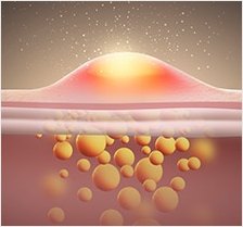 진피 속 염증과 혈관 증식을 표현한 3D 단면 일러스트